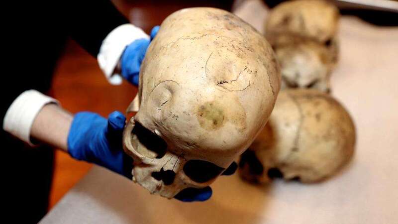 En la imagen, cráneo de un niño aborigen conservado en el Museo Canario que presenta dos fracturas en la parte frontal (Foto EFE)