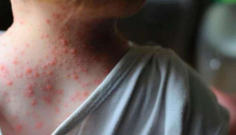 Persona afectada por la enfermedad/Multimedia.