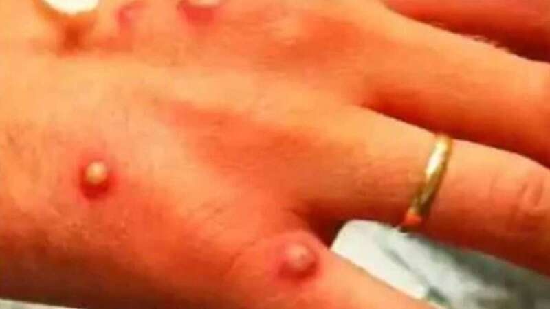 Viruela del mono/TA.