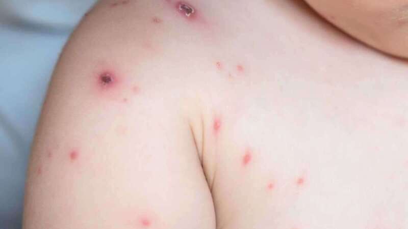 Persona afectada por la enfermedad/Multimedia.