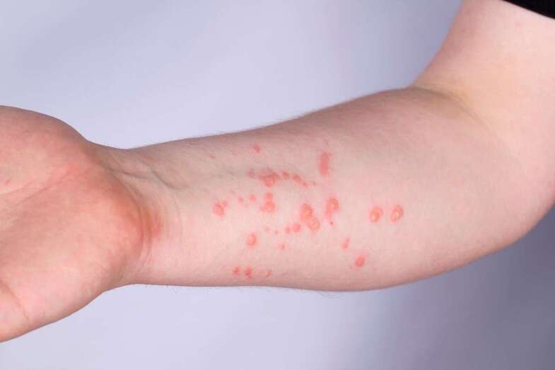 Manifestación de la enfermedad/TA.