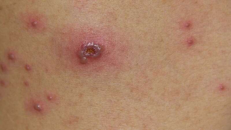 Pústula ocasionada por la viruela del mono/TA.