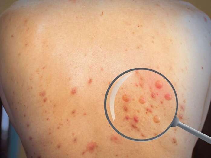 Persona afectada por la enfermedad/TA.