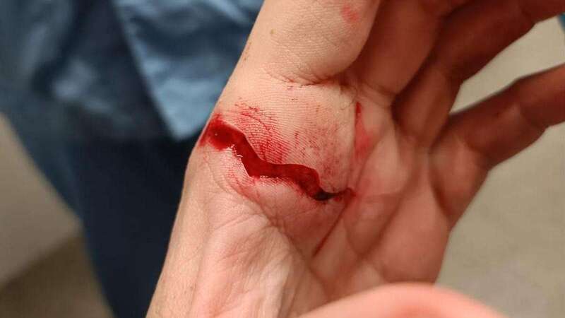 Corte en una mano que recibió el entrenador agredido/SER Las Palmas.