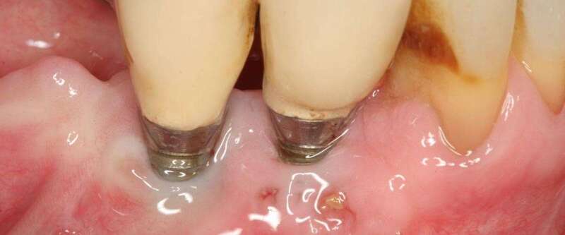 La periimplantitis es un proceso inflamatorio que afecta a los tejidos que rodean a un implante dental/TA.