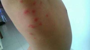 Imagen de las picaduras de pulgas en el niño (Foto TA)