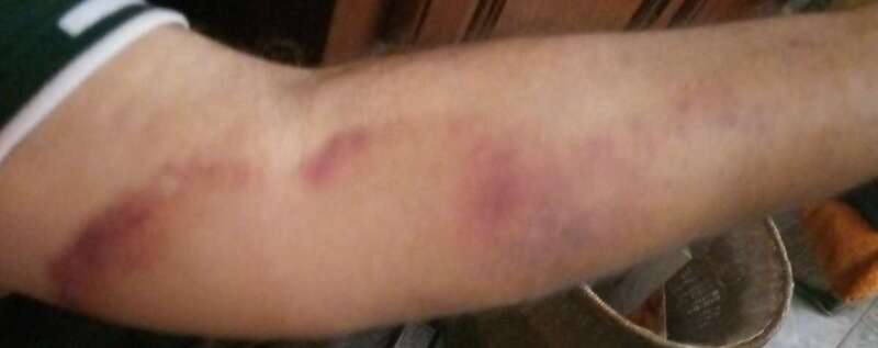 Imagen de las heridas que sufrió la persona afectada (Foto TA)