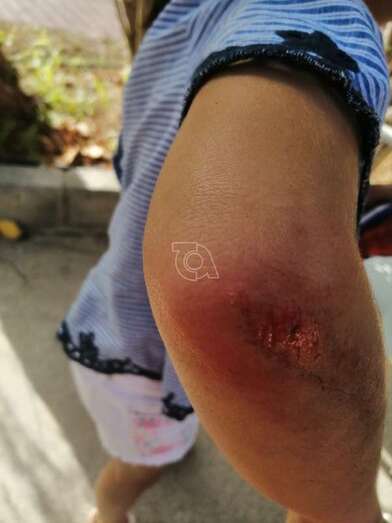 La hija de esta vecina sufrió una herida en el codo como consecuencia de una caída (Foto TA)