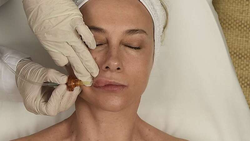 Simula ser médica jubilada e inyecta silicona en los labios a ocho mujeres (Foto Multimedia)