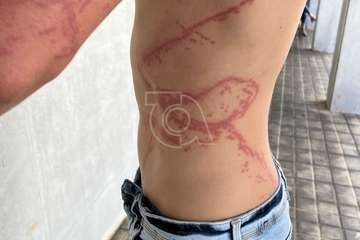 Un joven nadador sufre la brutal picadura de una carabela portuguesa en aguas de Melenara (Telde)/TA.