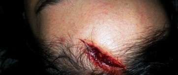 Brecha en la cabeza de Elisa T.B. (Foto TA)
