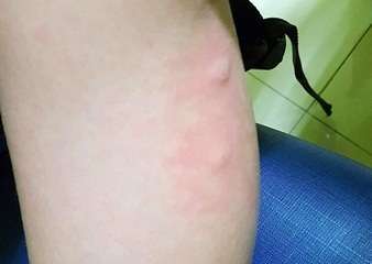 Picadura de pulga (Foto TA)