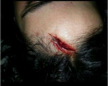 Herida de la joven supuestamente agredida por la Policía en Telde (Foto TA)