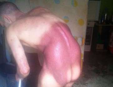 Juan Jesús Chamorro, con la espalda quemada por agua hirviendo (Foto TA)
