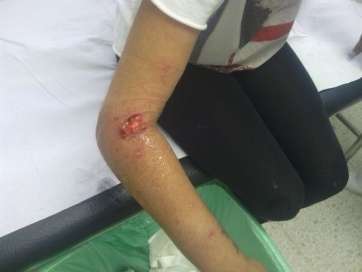 Imagen de archivo de una joven de Jinámar mordida por un perro (Foto TA)