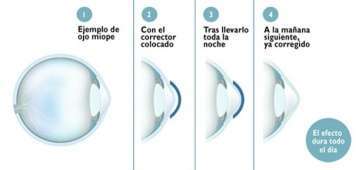 Explicación de la técnica de la ortoqueratología (Foto TA)