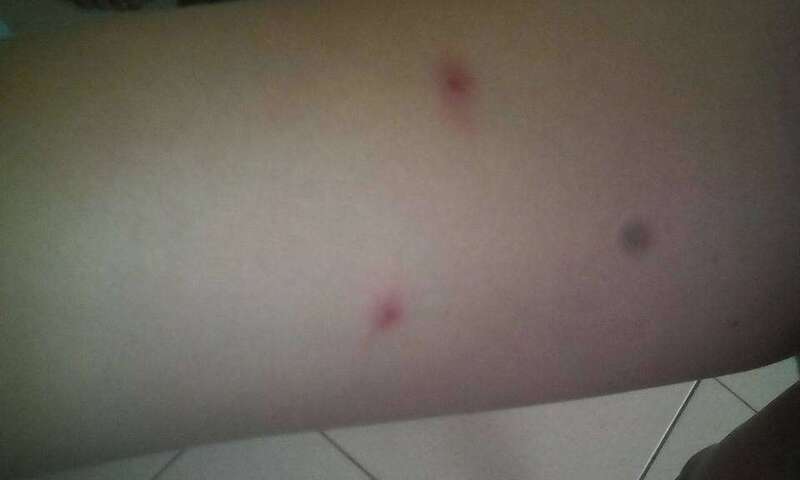 Imagen de las picadas de las pulgas (Foto TA)