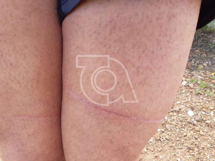 Imagen de un corte sufrido por un ciclista por uno de los cables colocados (Foto TA)