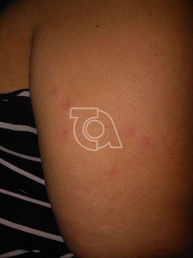 Imagen remitida por un residente en La Garita afectados por picaduras de pulgas (Foto TA)