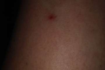 La Barranquera denuncia una plaga de pulgas asociada a una 