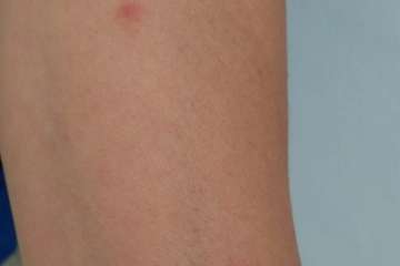 La Barranquera denuncia una plaga de pulgas asociada a una 