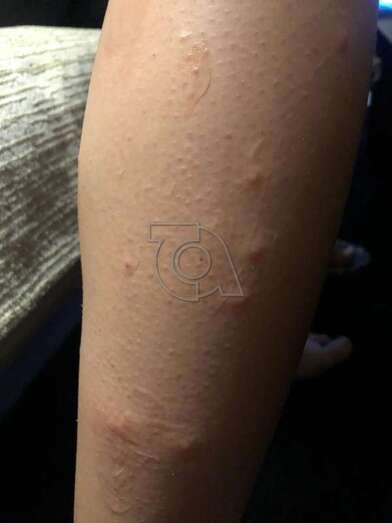 Picadas en la pierna de la joven teldense/TA.