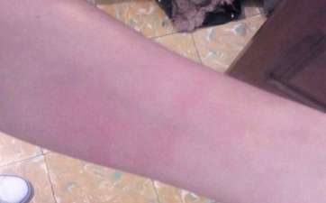 Marcas rojas que le dejó el suceso en el brazo (Foto TA)