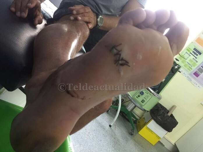 Los dientes quedaron marcados en el pie del surfero teldense