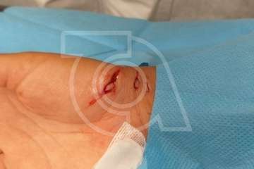 Una menor sufre la dentellada de un pez mientras se bañaba en Melenara (Foto TA)