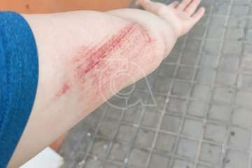 Un joven de Melenara se lesiona al caer en una arqueta de Endesa/TA.