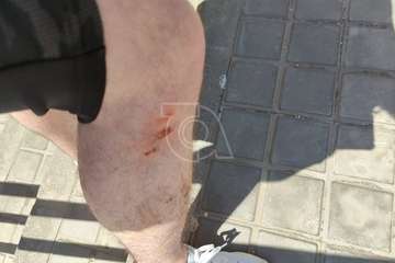 Un joven de Melenara se lesiona al caer en una arqueta de Endesa/TA.