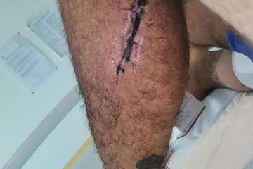 Heridas recibidas por Manuel Artiles/TA y C7.