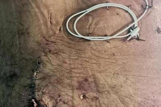 Heridas recibidas por Manuel Artiles/TA y C7.