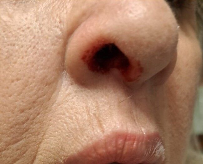 La afectada sufrió una lesión en la nariz/RAV.